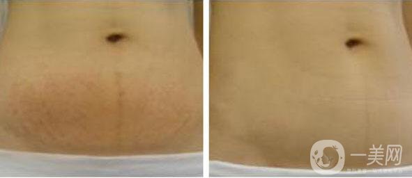 激光去妊娠紋,激光去妊娠紋費(fèi)用,深圳激光去妊娠紋費(fèi)用