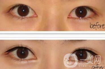 開眼角的后遺癥一般有哪些