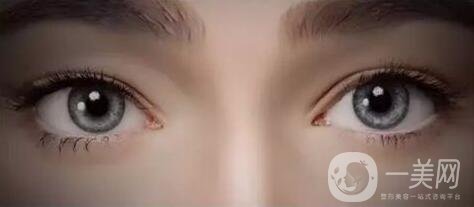 開眼角手術(shù)價格是多少？