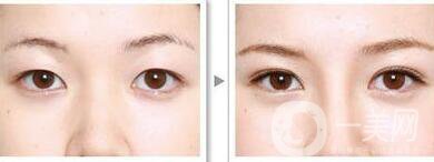 三點割雙眼皮是*的么