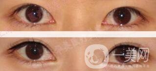 三點割雙眼皮是*的么