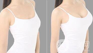 長(zhǎng)沙自體脂肪隆胸手術(shù)多少錢