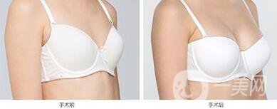 長(zhǎng)沙自體脂肪隆胸手術(shù)多少錢