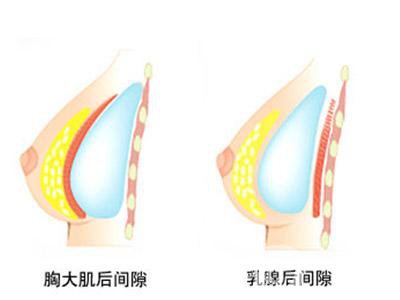 上海假體隆胸的價(jià)錢(qián)一般是多少