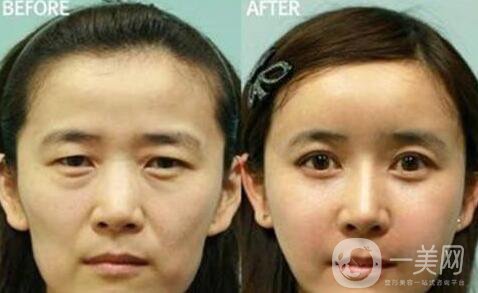 冰點(diǎn)拉皮*果怎么樣？