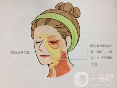 電波拉皮除皺*果好嗎？