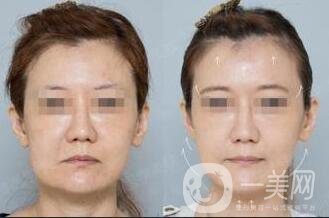 深圳埋線臉部提升價(jià)格多少