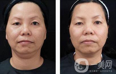 拉皮手術有些什么副作用