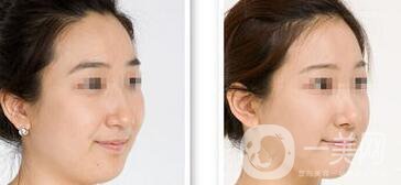 長(zhǎng)雙下巴怎么辦？減雙下巴的方法有哪些