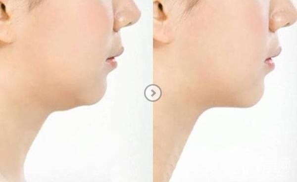 長(zhǎng)雙下巴怎么辦？減雙下巴的方法有哪些