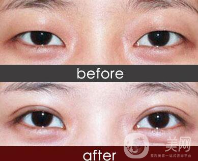 重慶埋線(xiàn)割雙眼皮多少錢(qián)