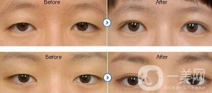 重慶埋線(xiàn)割雙眼皮多少錢(qián)
