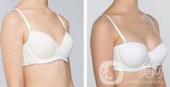 假體豐胸術(shù)后注意事項(xiàng)詳細(xì)介紹