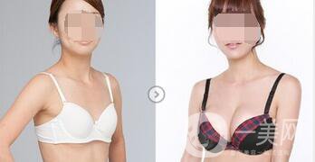 假體豐胸術(shù)后注意事項(xiàng)詳細(xì)介紹