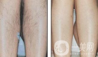 北京激光脫毛的價格到底是多少