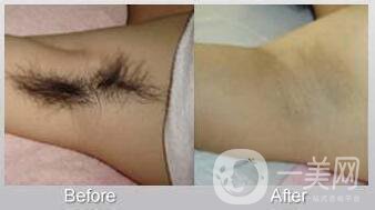 北京激光脫毛的價格到底是多少