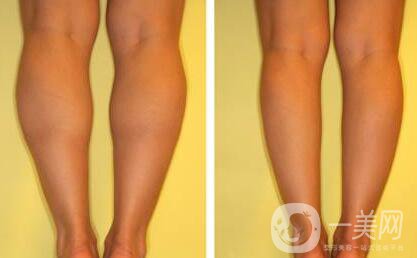 廣州注射*一針多少錢