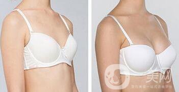 正規(guī)醫(yī)院做假體豐胸多少錢