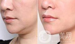 怎樣去掉雙下巴的方法介紹