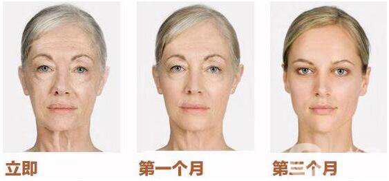 拉皮手術(shù)多少錢,北京臉部拉皮手術(shù)多少錢