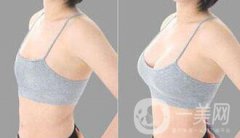 假體豐胸大小是自己選嗎