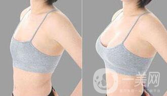 假體豐胸大小是自己選嗎