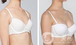 假體豐胸大小是自己選嗎