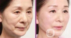 拉皮怎樣做？拉皮果有哪些？