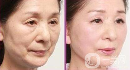 拉皮怎樣做？拉皮*果有哪些？