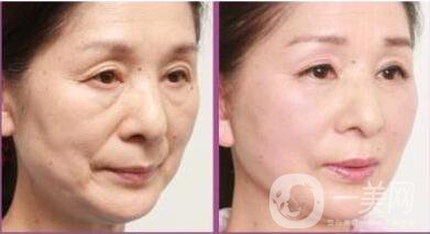 超聲波美容拉皮手術(shù)的價(jià)格一般是多少錢左右