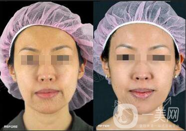 熱瑪吉與電波拉皮手術(shù)的區(qū)別有些什么