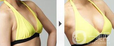 蘇州假體隆胸一般多少錢