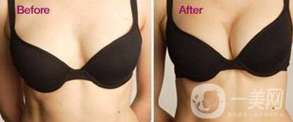 蘇州假體隆胸一般多少錢