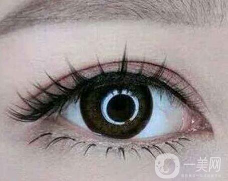 割雙眼皮怎樣可以快速消腫？