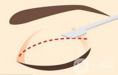 割雙眼皮手術(shù)后如何消腫更快