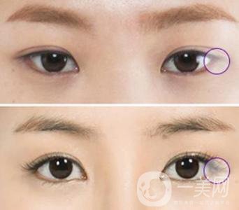 開眼角手術(shù)的風(fēng)險主要有哪些