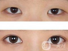 開眼角眼睛變化大嗎？