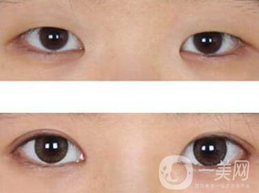 開眼角眼睛變化大嗎？