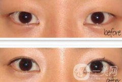韓式開眼角整形果到底怎么樣