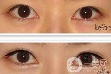 韓式開眼角整形*果到底怎么樣