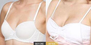 假體豐胸多久可以洗頭