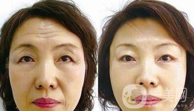 電波拉皮有用嗎  除皺緊膚一步到位