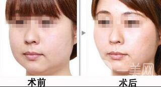 光纖溶脂減肥*果*嗎