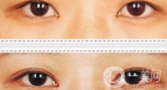 割雙眼皮加開眼角果怎么樣