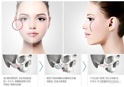 顴骨磨削術(shù)削哪里 術(shù)后護理介紹 2
