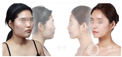 顴骨磨削術(shù)削哪里 術(shù)后護理介紹 3