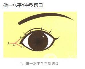 什么是開眼角手術(shù) 術(shù)后如何護(hù)理 2