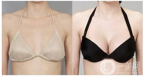 娜高220假體豐胸有多大 娜高豐胸有哪些優(yōu)勢 1
