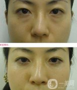電波拉皮去眼袋果怎么樣？