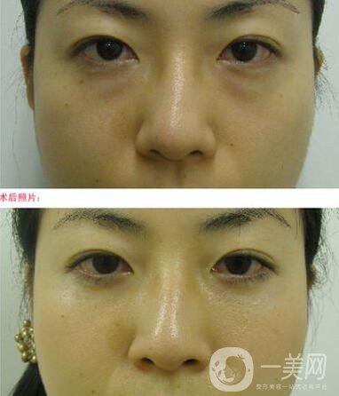 電波拉皮去眼袋*果怎么樣？